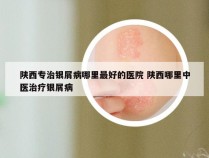 陕西专治银屑病哪里最好的医院 陕西哪里中医治疗银屑病