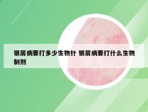 银屑病要打多少生物针 银屑病要打什么生物制剂
