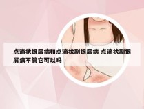 点滴状银屑病和点滴状副银屑病 点滴状副银屑病不管它可以吗