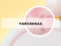 牛皮癣引发的龟头炎
