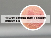 特比萘芬对加重银屑病 盐酸特比萘芬凝胶对银屑病有效果吗