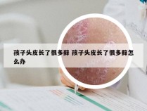 孩子头皮长了很多藓 孩子头皮长了很多藓怎么办