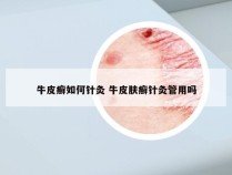 牛皮癣如何针灸 牛皮肤癣针灸管用吗