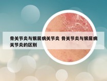 骨关节炎与银屑病关节炎 骨关节炎与银屑病关节炎的区别