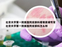 北京大学第一附属医院皮肤科看银屑病专家 北京大学第一附属医院皮肤科怎么样