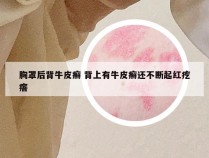 胸罩后背牛皮癣 背上有牛皮癣还不断起红疙瘩