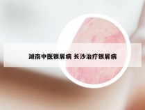 湖南中医银屑病 长沙治疗银屑病