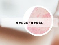 牛皮癣可以打狂犬疫苗吗