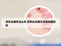 常熟白癜风怎么样 常熟白内障手术哪家医院好