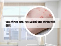 银屑病河北医保 河北省治疗银屑病的有哪些医院