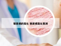 银屑病的变化 银屑病变化莫测