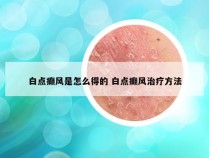 白点癫风是怎么得的 白点癫风治疗方法