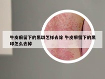 牛皮癣留下的黑斑怎样去除 牛皮癣留下的黑印怎么去掉