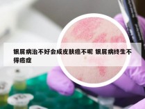 银屑病治不好会成皮肤癌不呢 银屑病终生不得癌症