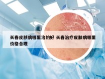 长春皮肤病哪里治的好 长春治疗皮肤病哪里价格合理