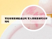 军检有银屑病能通过吗 军人得银屑病可以评残吗