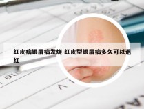 红皮病银屑病发烧 红皮型银屑病多久可以退红