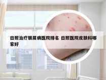 日照治疗银屑病医院排名 日照医院皮肤科哪家好