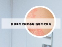 指甲里牛皮癣也不痒 指甲牛皮皮癣
