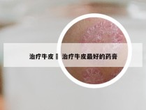 治疗牛皮廯 治疗牛皮最好的药膏
