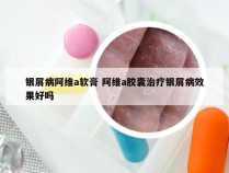 银屑病阿维a软膏 阿维a胶囊治疗银屑病效果好吗