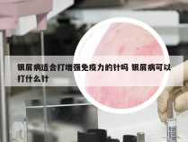 银屑病适合打增强免疫力的针吗 银屑病可以打什么针
