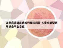 儿童点滴银屑病如何预防感冒 儿童点滴型银屑病会不会自愈