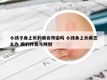 小孩子身上长的癣会传染吗 小孩身上长癣怎么办 癣的种类与辨别