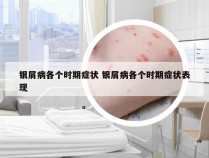 银屑病各个时期症状 银屑病各个时期症状表现