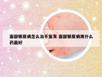 面部银屑病怎么治不复发 面部银屑病用什么药最好