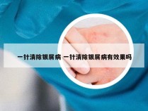 一针清除银屑病 一针清除银屑病有效果吗