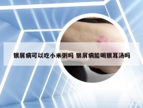 银屑病可以吃小米粥吗 银屑病能喝银耳汤吗