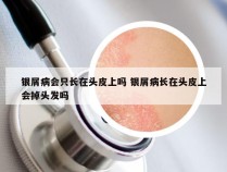 银屑病会只长在头皮上吗 银屑病长在头皮上会掉头发吗