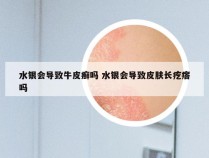 水银会导致牛皮癣吗 水银会导致皮肤长疙瘩吗
