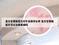 复方甘草酸苷片对牛皮癣评论吧 复方甘草酸苷片可以治银屑病吗