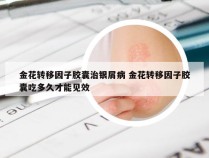 金花转移因子胶囊治银屑病 金花转移因子胶囊吃多久才能见效