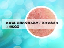 银屑病打完新冠疫苗又起来了 银屑病患者打了新冠疫苗