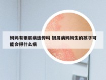 妈妈有银屑病遗传吗 银屑病妈妈生的孩子可能会得什么病