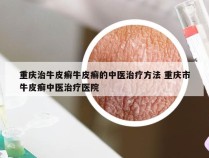 重庆治牛皮癣牛皮癣的中医治疗方法 重庆市牛皮癣中医治疗医院