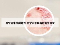 南宁治牛皮癣地方 南宁治牛皮癣地方有哪些