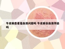 牛皮癣患者是血液问题吗 牛皮癣会血液传染吗