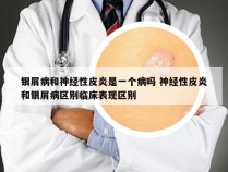 银屑病和神经性皮炎是一个病吗 神经性皮炎和银屑病区别临床表现区别