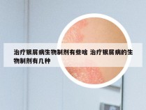 治疗银屑病生物制剂有些啥 治疗银屑病的生物制剂有几种