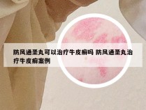 防风通圣丸可以治疗牛皮癣吗 防风通圣丸治疗牛皮癣案例