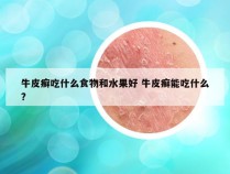 牛皮癣吃什么食物和水果好 牛皮癣能吃什么?