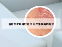 治疗牛皮癣得好方法 治疗牛皮癣的办法