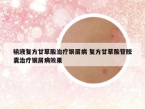 输液复方甘草酸治疗银屑病 复方甘草酸苷胶囊治疗银屑病效果