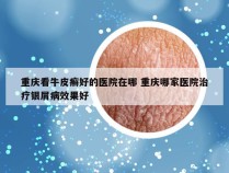 重庆看牛皮癣好的医院在哪 重庆哪家医院治疗银屑病效果好