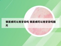 银屑病可以用牙膏吗 银屑病可以用牙膏吗图片