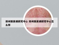 郑州银屑病研究中心 郑州银屑病研究中心怎么样